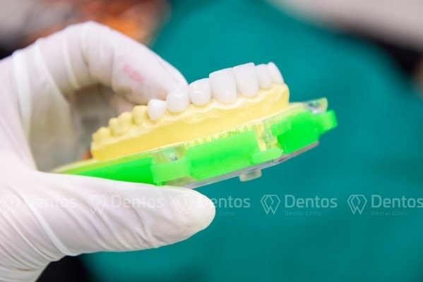 Răng sứ là vật liệu nha khoa phổ biến trong kỹ thuật phục hình thẩm mỹ nha khoa